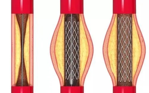 派瑞林Parylene涂层用于血管支架的防护作用图3