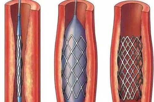 派瑞林Parylene涂层用于血管支架的防护作用图4